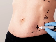 Lipoaspiração Lipoaspiração.