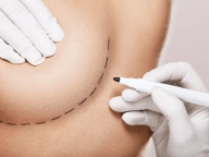 Mamoplastia Mamoplastia.