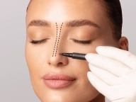 Rinoplastia Rinoplastia.